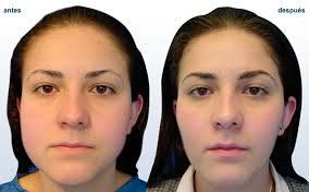 Quiero Adelgazar La Cara