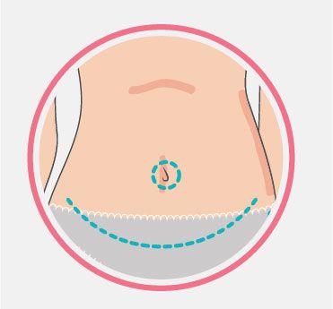 05-abdominoplastia.jpg